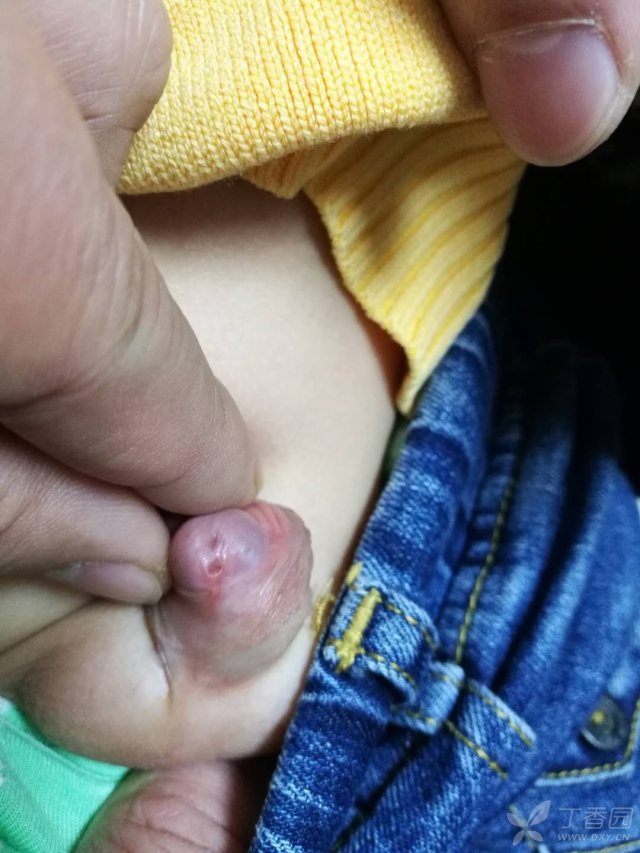 小儿尿道下裂知名专家解析与治疗策略