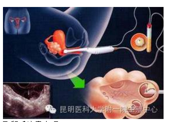 试管打针与取卵，现代生殖技术的细致流程