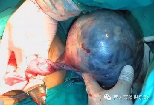 试管取卵后腹水图片，了解与处理