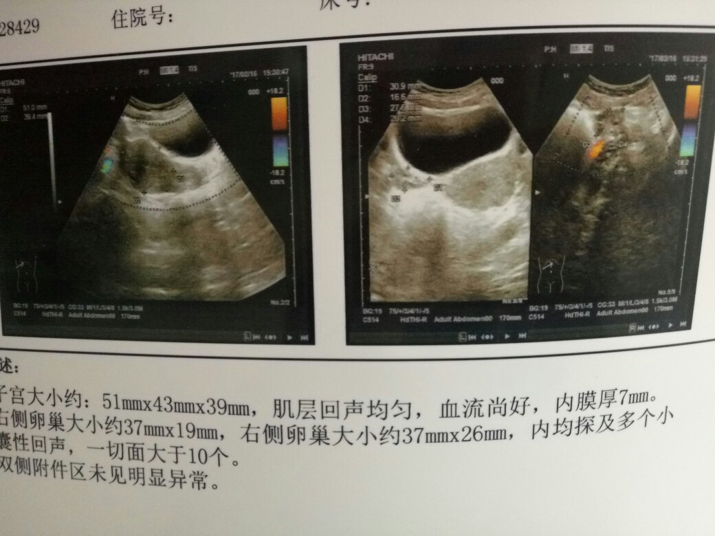 小卵泡取卵后能否使用的探讨