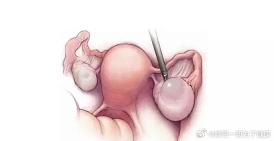 取卵第二天肚子变大，原因、观察与护理